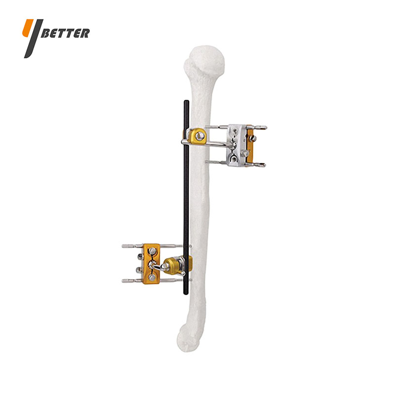 肱骨骨干骨折固定支架